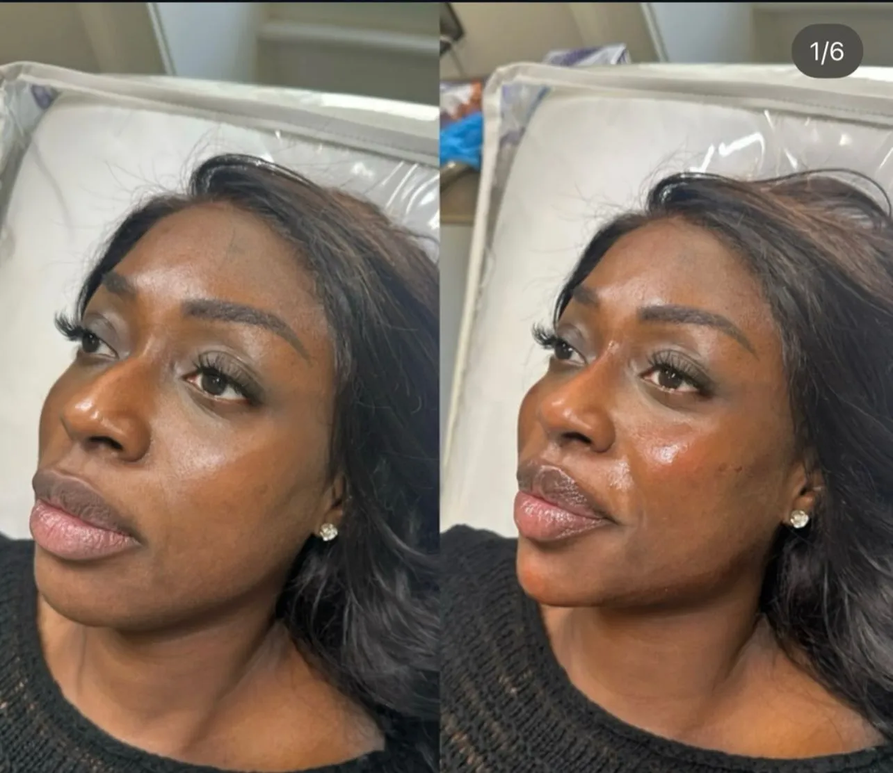 Cheek and Chin Filler result