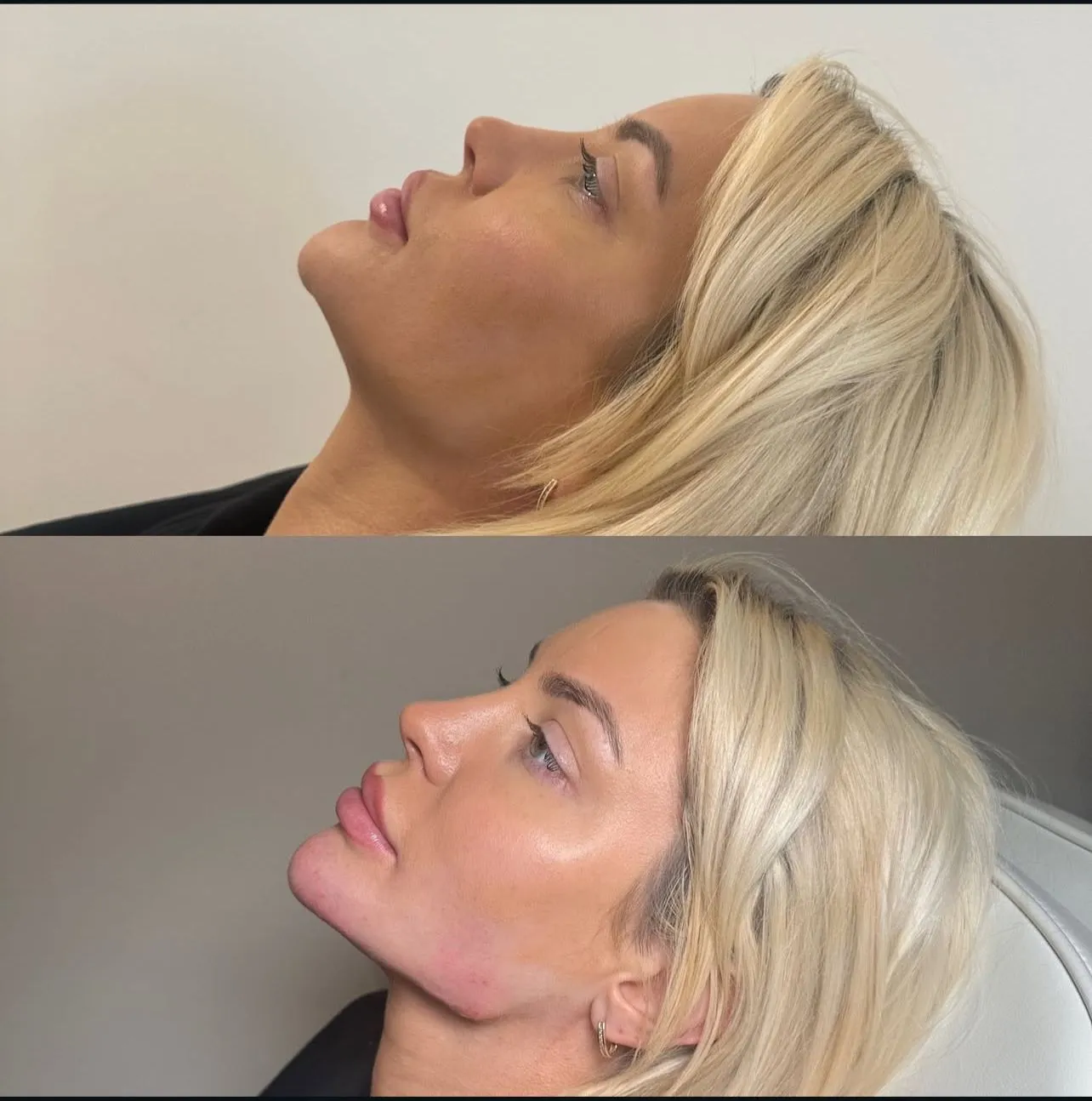 Jawline Filler result