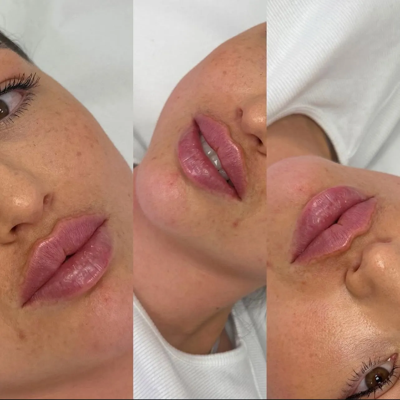 Lip Injections result