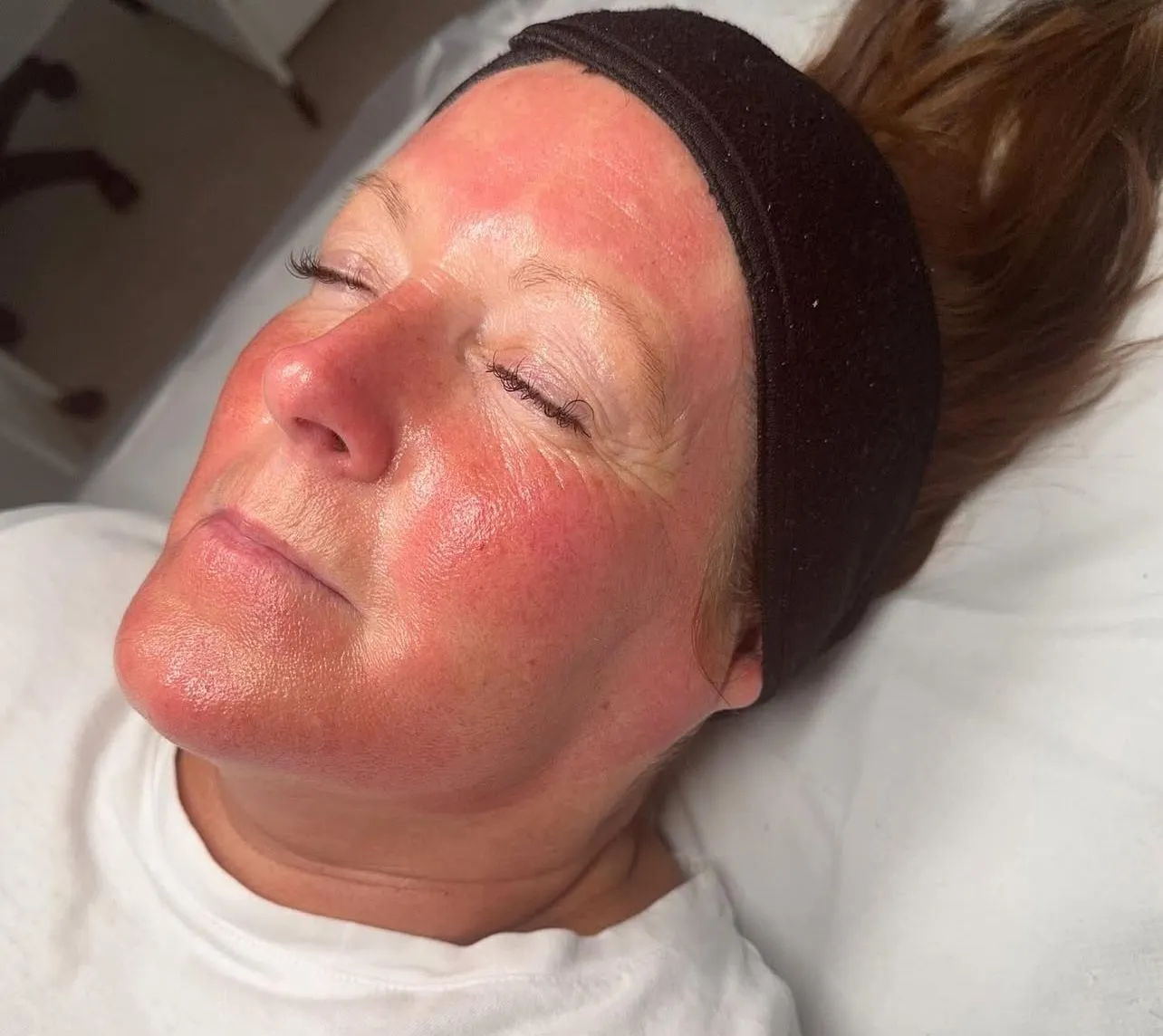 Microneedling result